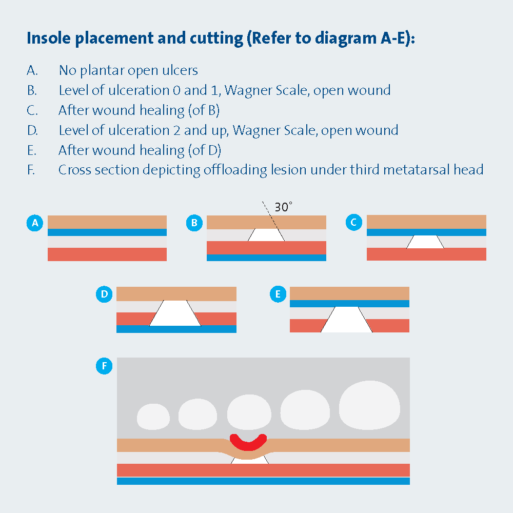 
                  
                    Instructions for skiving offloading insoles for the WCS and WCC Wound Care Shoes
                  
                